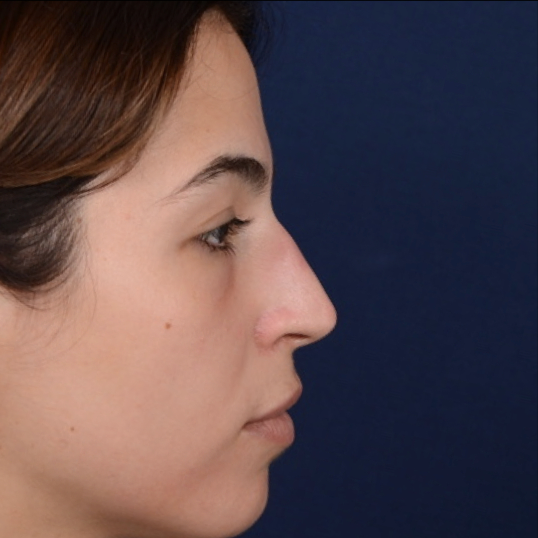 rinoplastia-04-01 Rhinoplasty