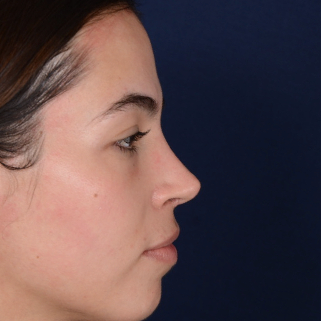 rinoplastia-04-02 Rhinoplasty