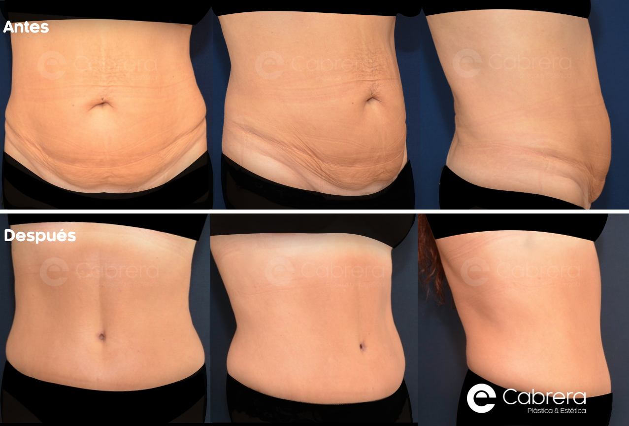 5123C Antes y después en abdominoplastia
