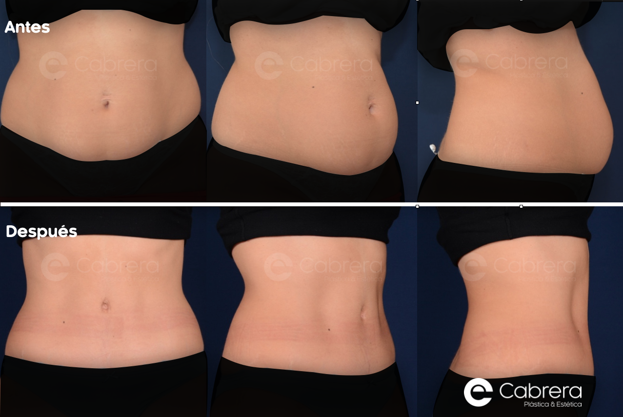 6003C Antes y después en abdominoplastia