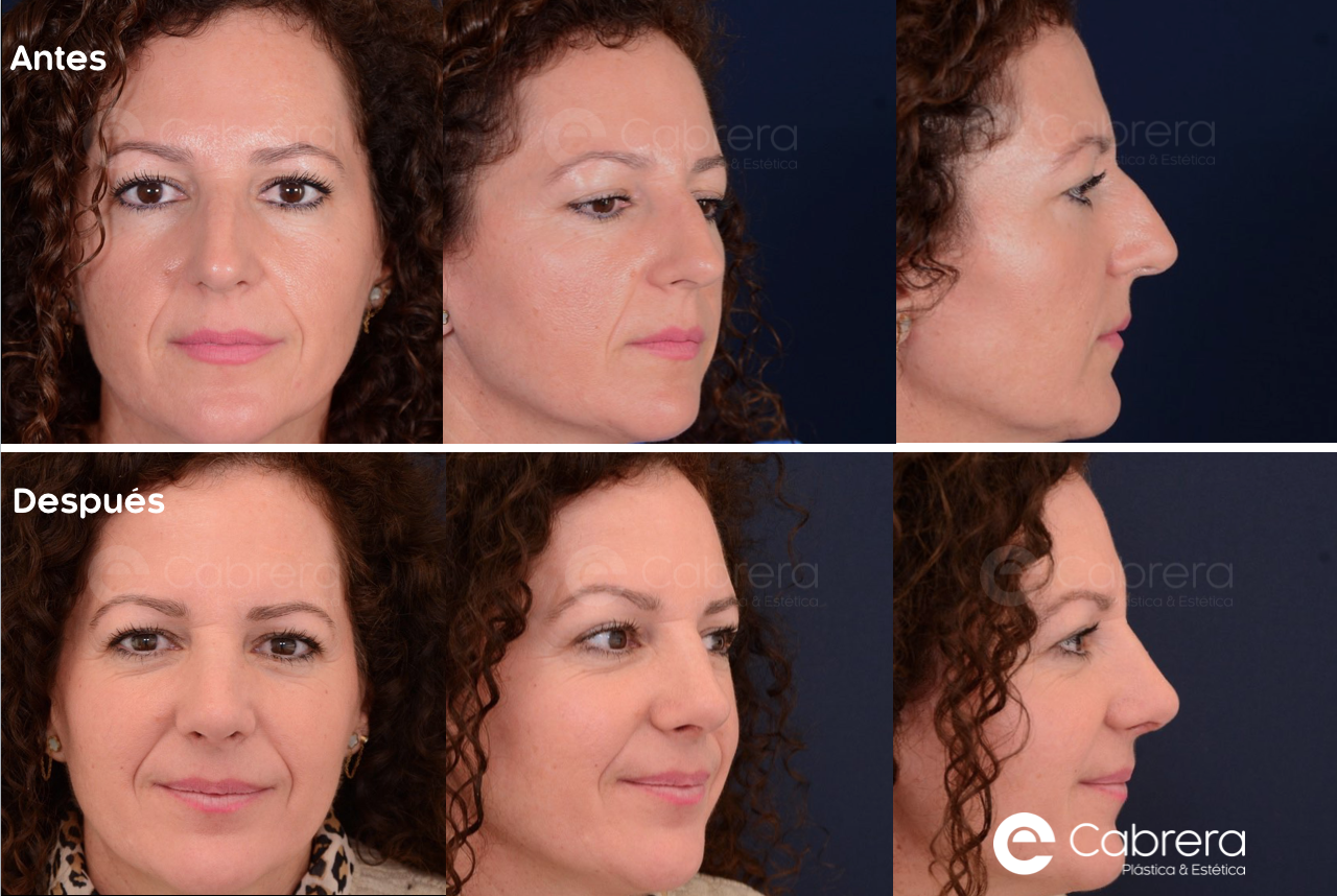 6122C Antes y después en rinoplastia