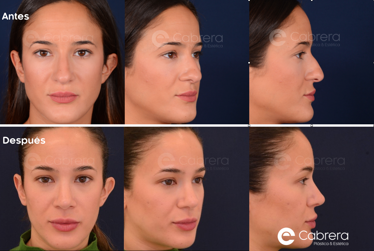 6750C12M-1 Antes y después en rinoplastia