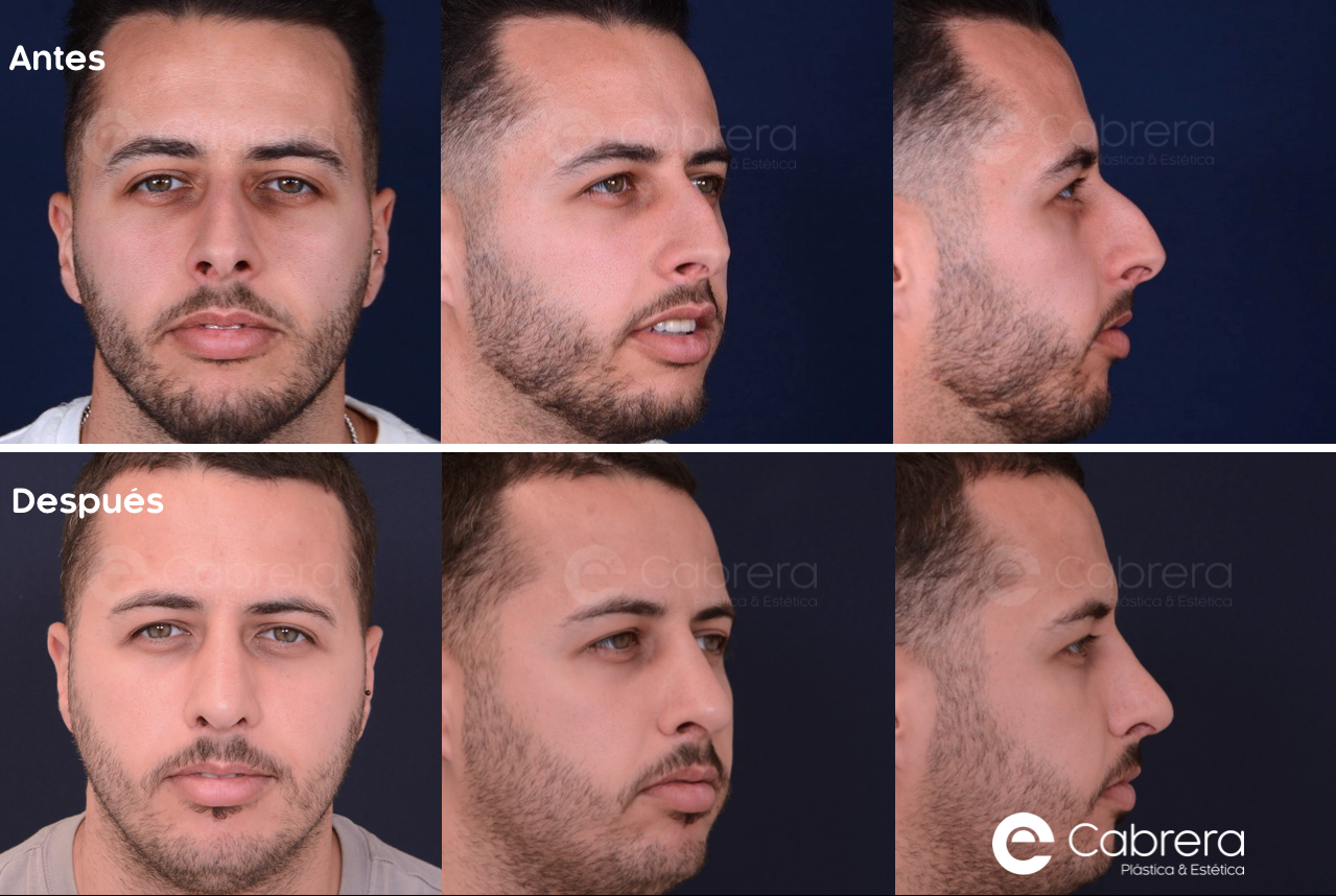 8863C-1 Antes y después en rinoplastia