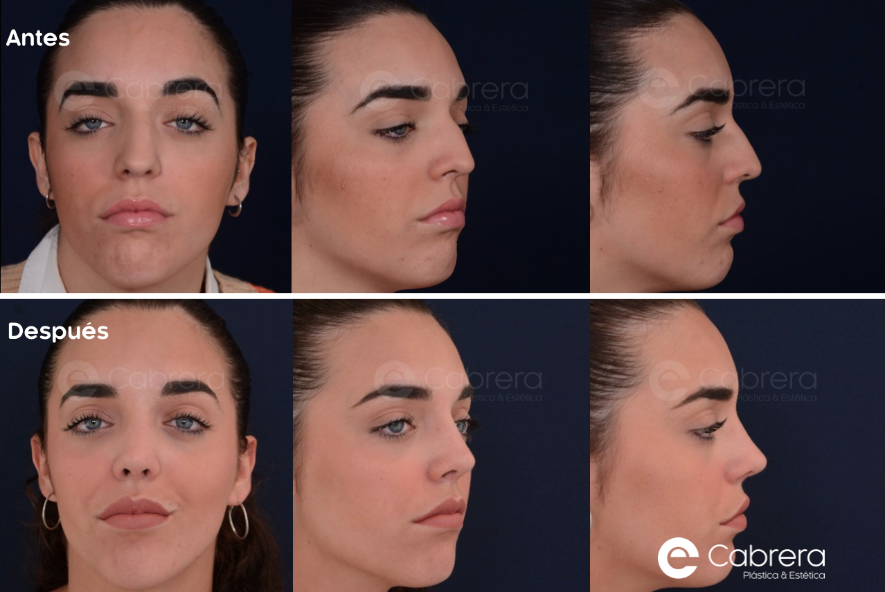 9459C-2 Antes y después en rinoplastia