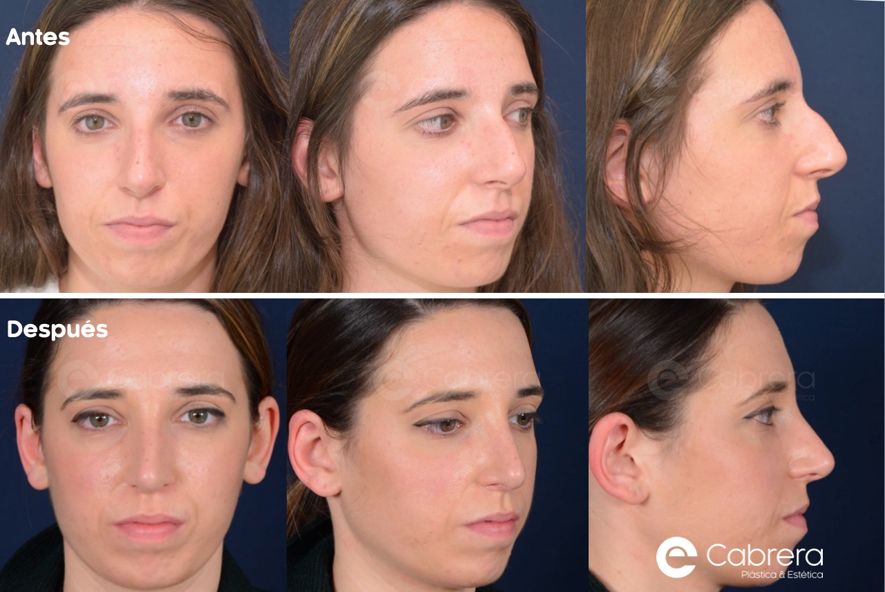 6004 Antes y después en rinoplastia