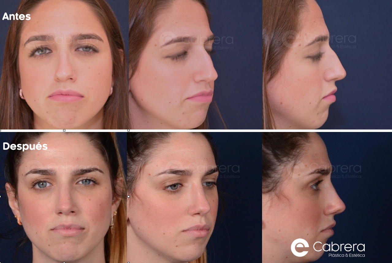 6056 Antes y después en rinoplastia