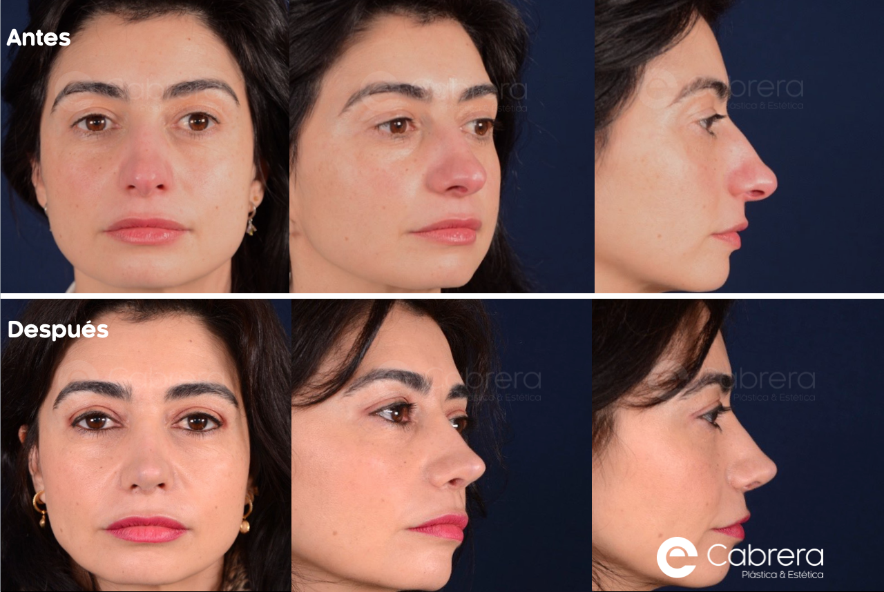 7338-1 Antes y después en rinoplastia