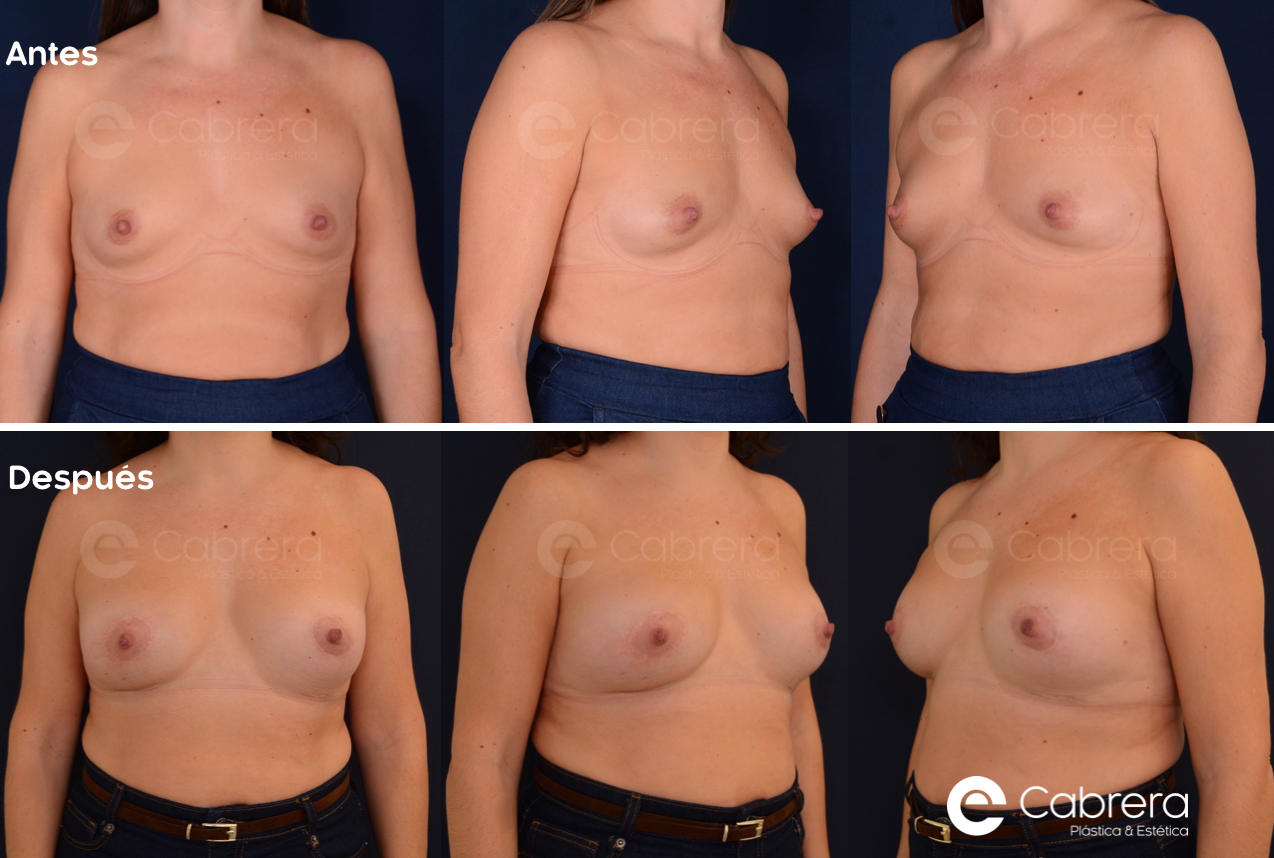 8725c Antes y después en mamas tuberosas