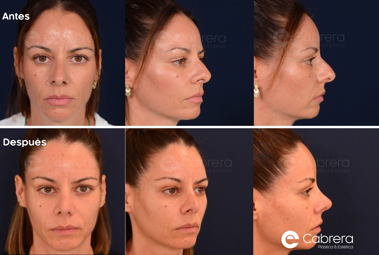 2784Wc Antes y después en rinoplastia