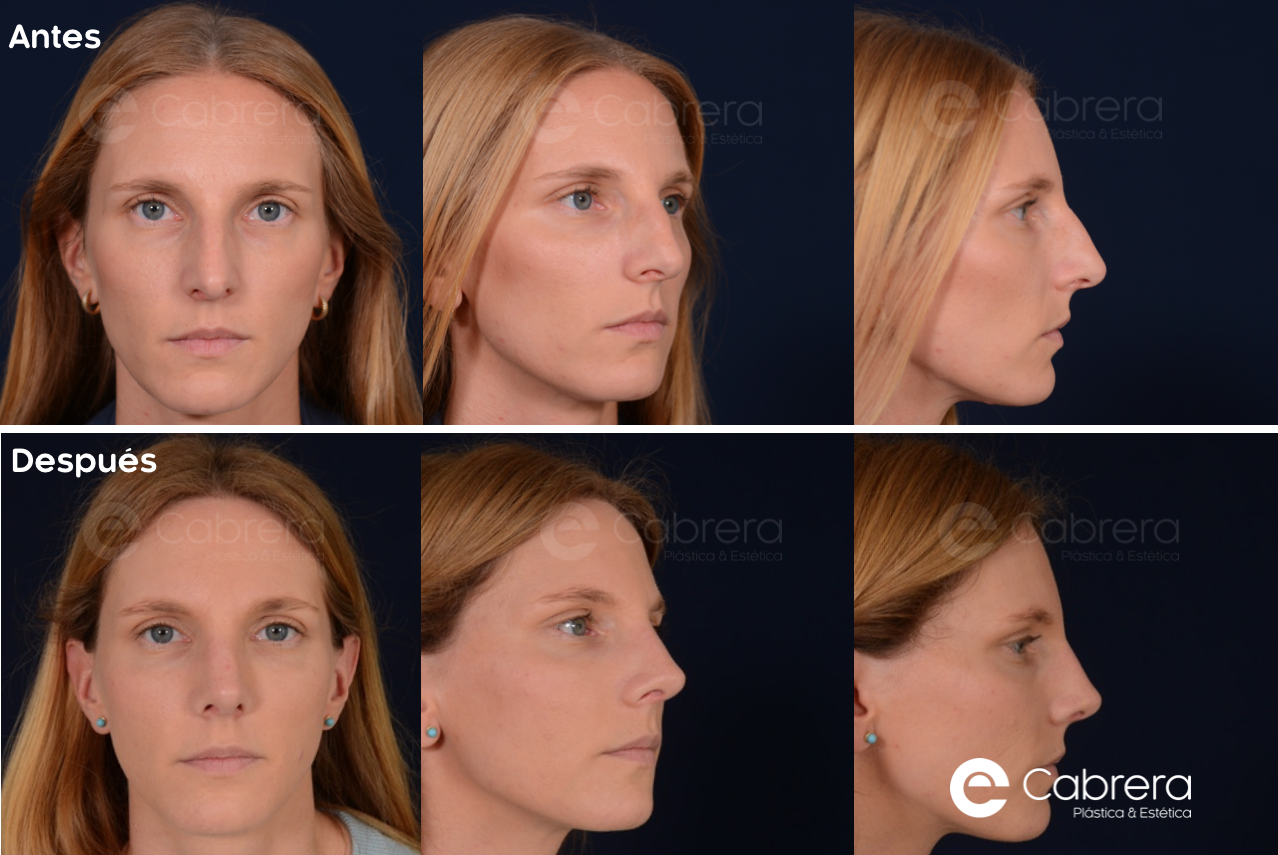9587Wc Antes y después en rinoplastia