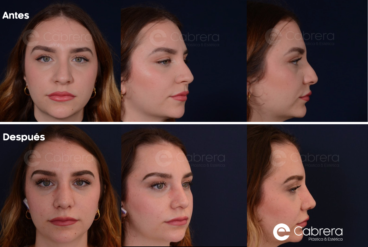 10001WC Antes y después en rinoplastia