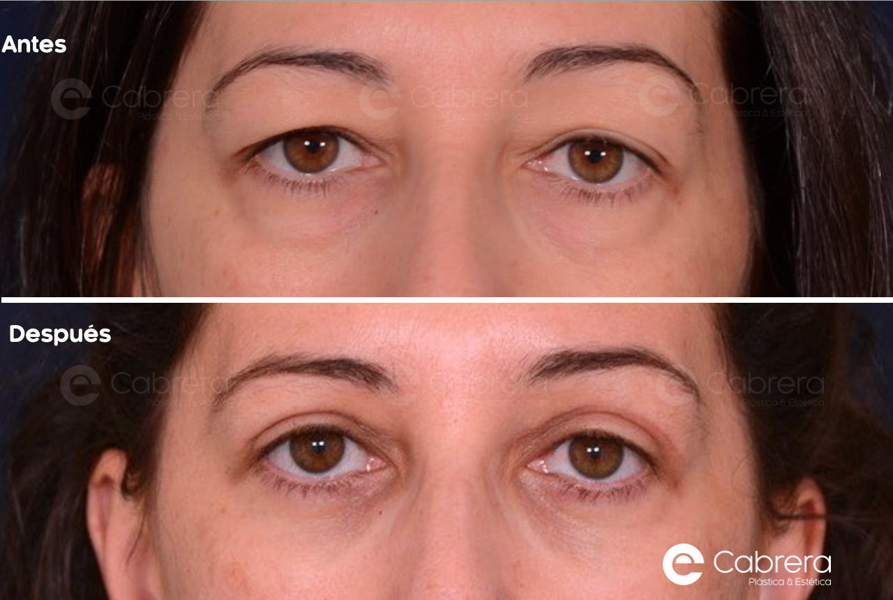 10003WC Antes y después en blefaroplastia