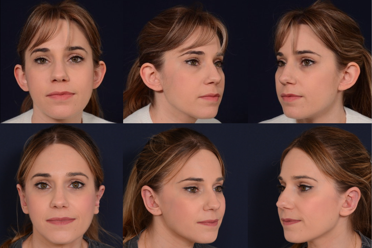10080WC Antes y después en otoplastia
