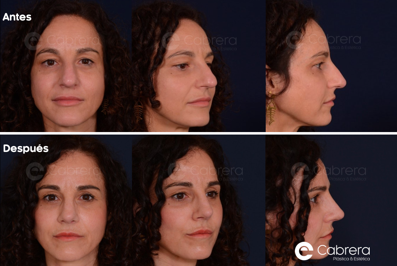 7617WC Antes y después en rinoplastia