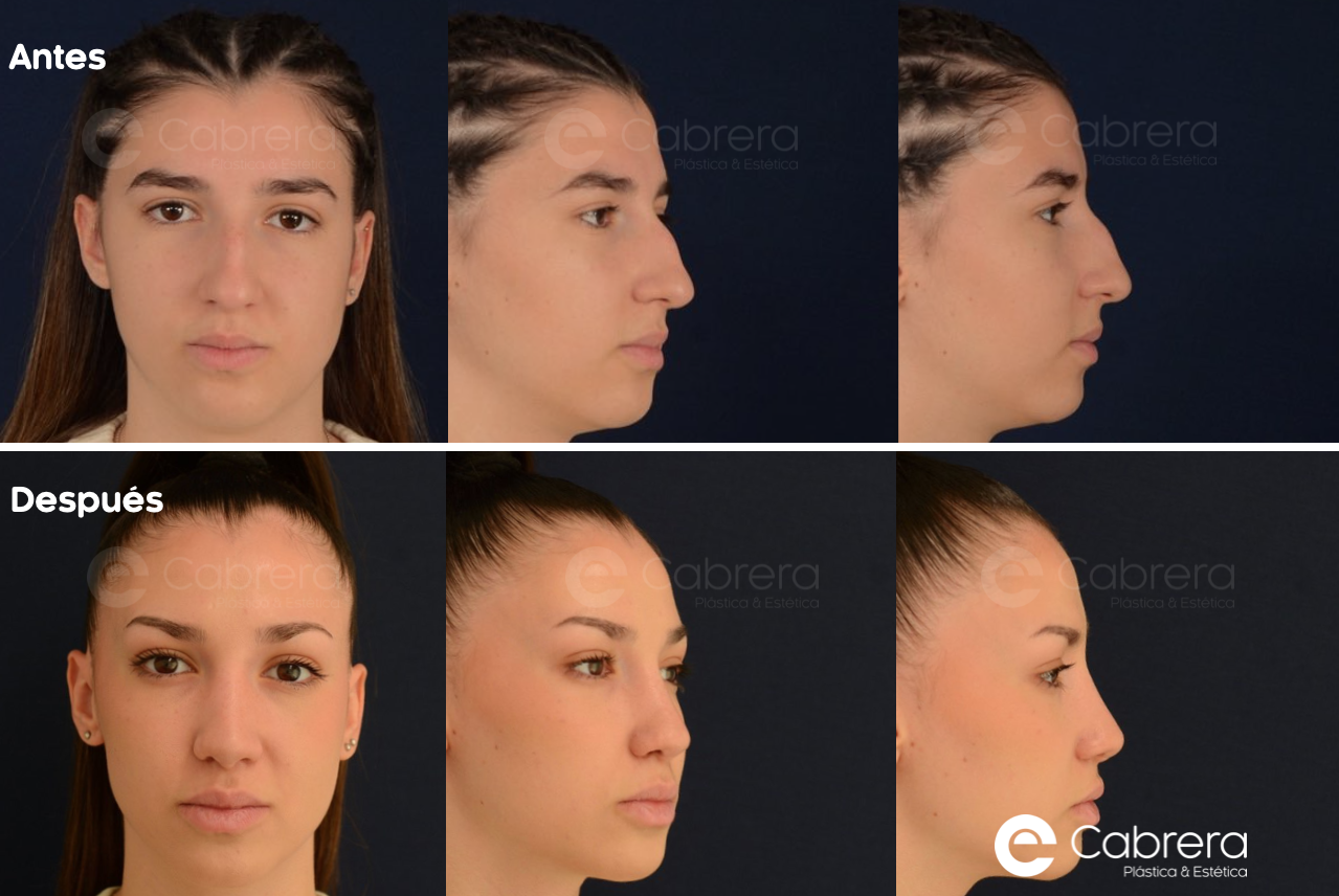 8846WC Antes y después en rinoplastia