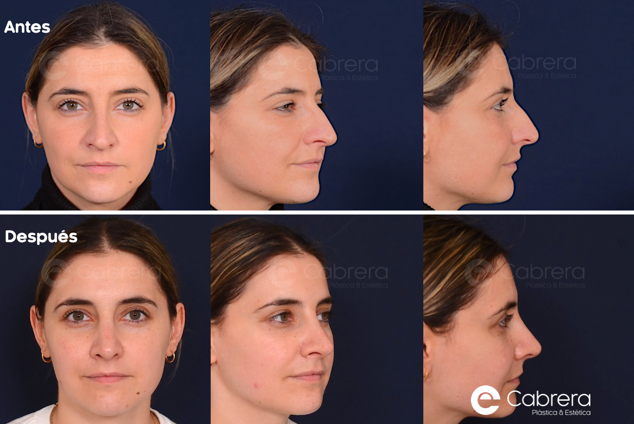 9633WC Antes y después en rinoplastia