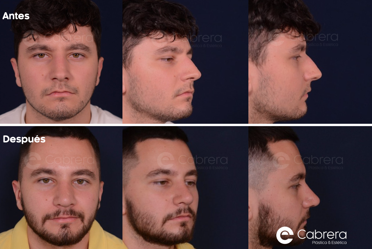 9834WC Antes y después en rinoplastia
