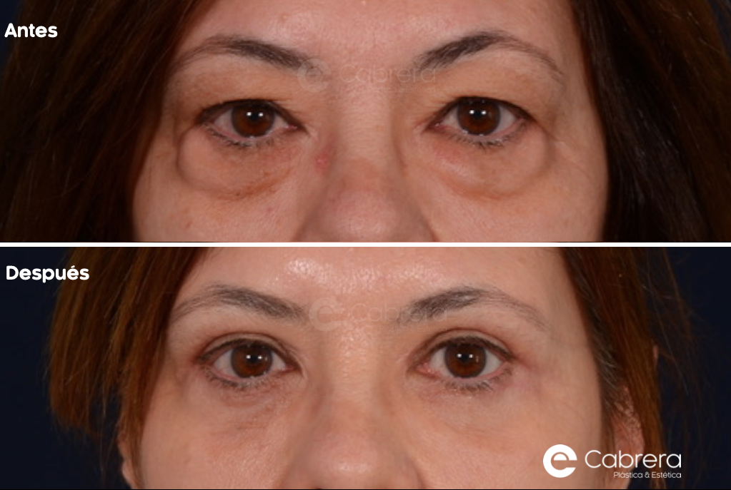 9934WC Antes y después en blefaroplastia