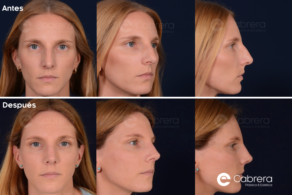 9587wc Antes y después en rinoplastia