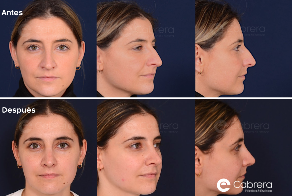 9633wc Antes y después en rinoplastia